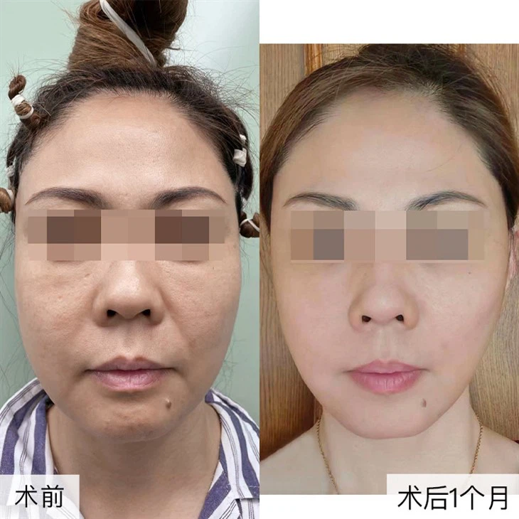2Facial rejuvenation surgery
